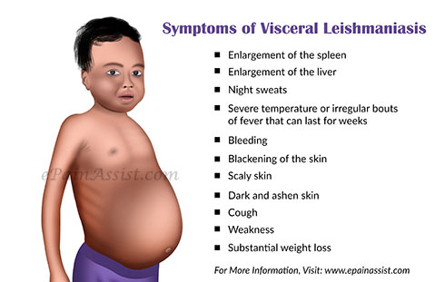 visceral-leishmaniasis