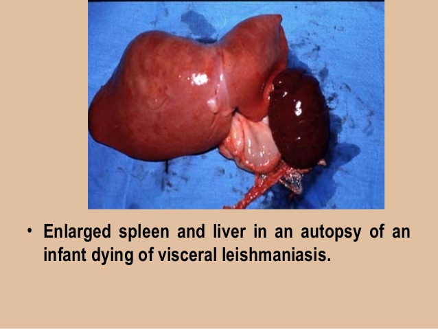 dr-sanjay-s-negi-leishmaniasis-18-638