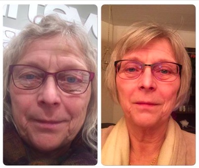 utmattad, utmattningssyndrom, stress