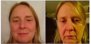 tecken på utbrändhet