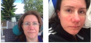 utmattad, utmattningssyndrom, stress